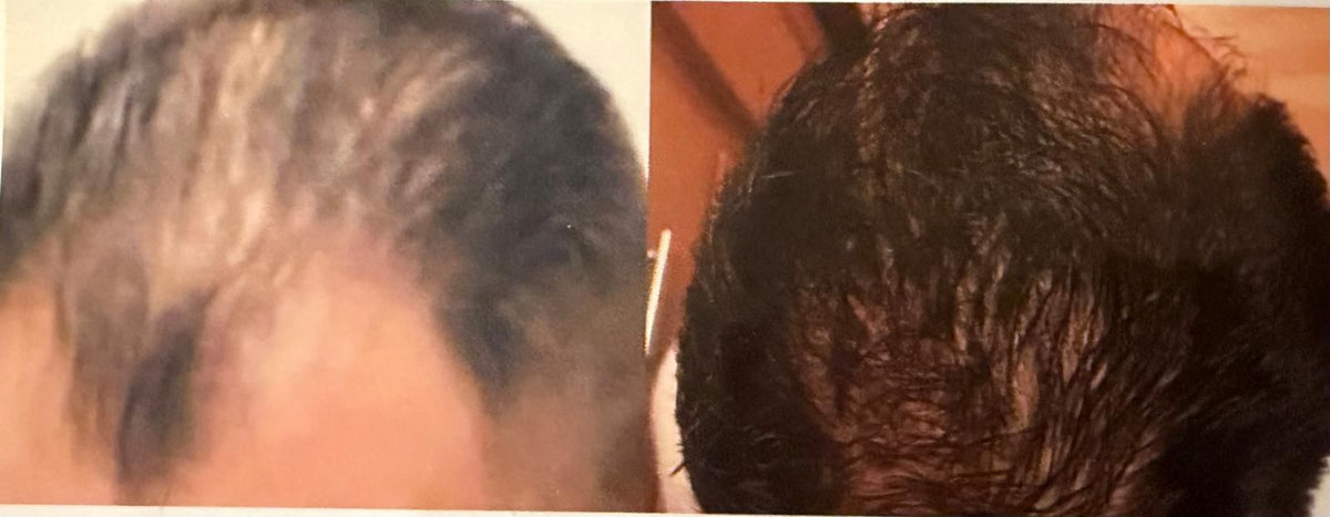 Anti-Hair Loss Growth Dropper | Gotero Anti Caída y Crecimiento